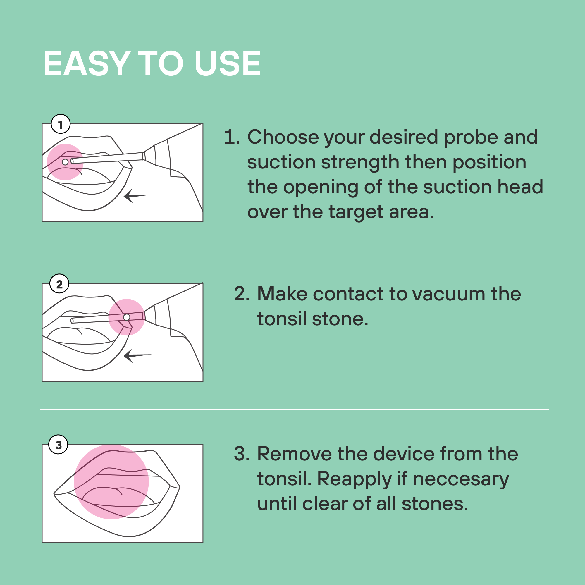 Clearstone Vacuum Tonsil Stone Remover